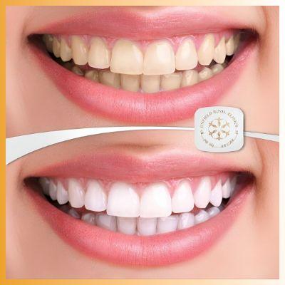 Nano Teeth Whitening in Islamabad
