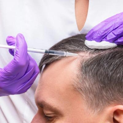 What Are the Benefits of Exosome Therapy for Hair Loss