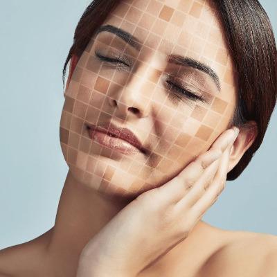 What Are the Different Types of Hyperpigmentation