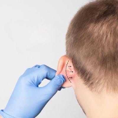 What are the Common Reasons For Considering Otoplasty?