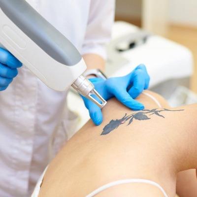Worried About Your Tattoo The Solution is in Islamabad