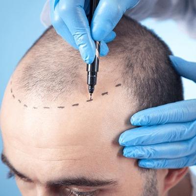 hair transplant in pakistan