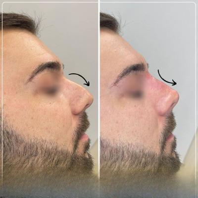 Best Clinics for Rhinoplasty in Islamabad Safe and Trusted