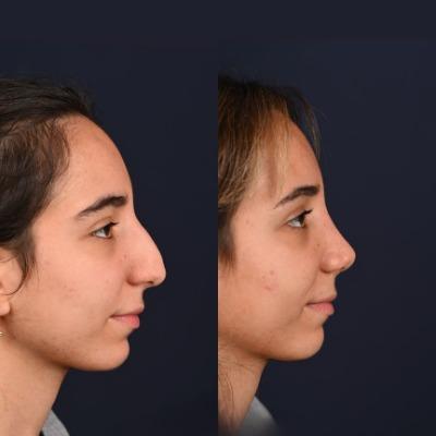 What Are the Signs of a Good Rhinoplasty Result in Islamabad