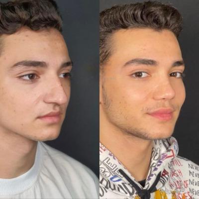 What Is the Difference Between Open and Closed Rhinoplasty?