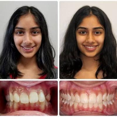 Which Clinic Has The Highest Success Rate for Bite Correction