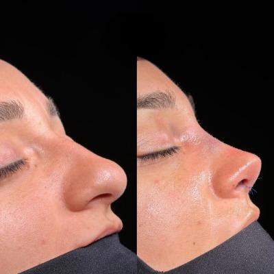 Why Should You Choose Rhinoplasty in Islamabad