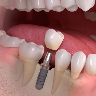 Can dental implants be done without bone grafting