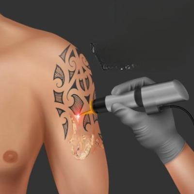 Can tattoos be removed permanently by laser?
