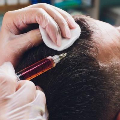Is PRP Hair Treatment Better Than Medicines