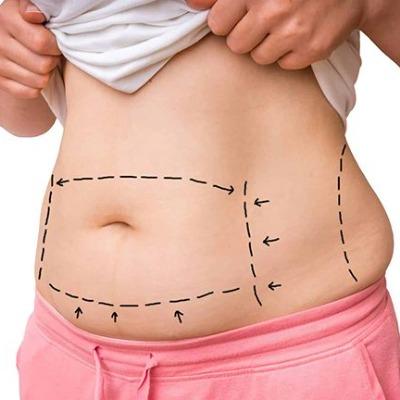 Liposuction Clinic in Islamabad, Pakistan