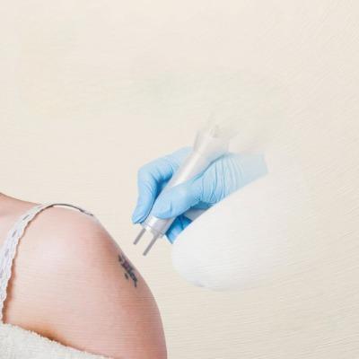 Will Laser Tattoo Removal Leave Any Marks or Scars