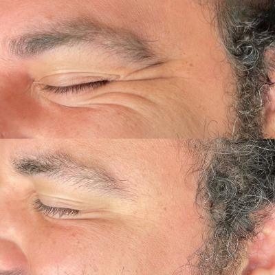 How Long Does Botox Typically Last?