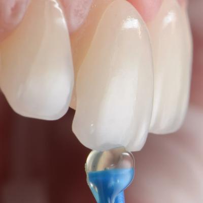 How Many Visits Are Required for Dental Veneers in Islamabad