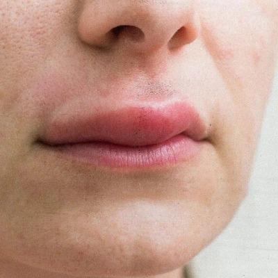 How long do lips stay swollen after surgery?