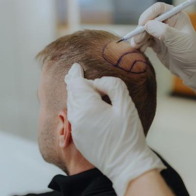 Is PRP Hair Therapy Affordable in Islamabad