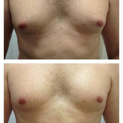 Is Surgery the Only Way to Treat Gynecomastia?
