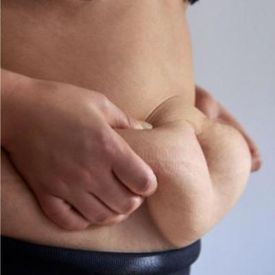 Liposuction Cost, Safety, and Results in Islamabad