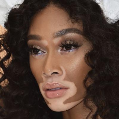 Vitiligo Treatment in Islamabad