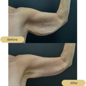 armlift after before