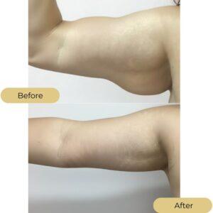 armlift before after