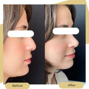 before after ultrasonic rhinoplasty
