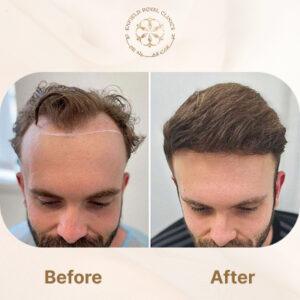 hair wig before after
