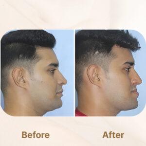 jaw surgery after before