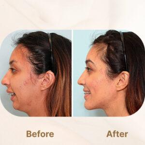 jaw surgery before after
