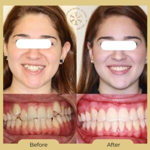 teeth aligners after before