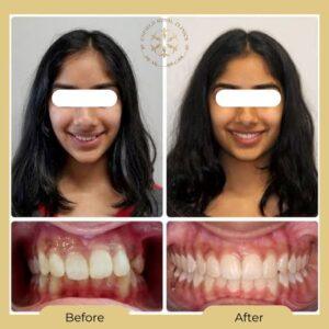 teeth aligners before after