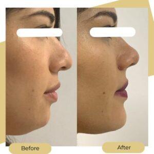 ultrasonic rhinoplasty after before