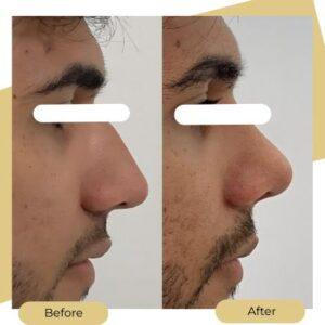 ultrasonic rhinoplasty after before