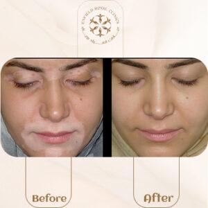 vitiligo before after