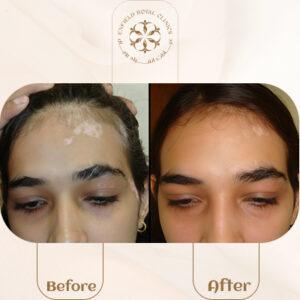 vitiligo before after in islamabad