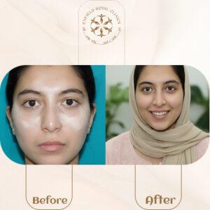 vitiligo treatment before after
