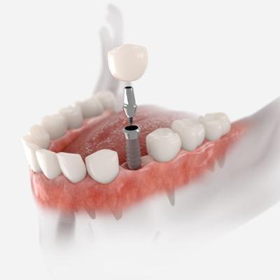 Best Dental Implants in Islamabad pakistan
