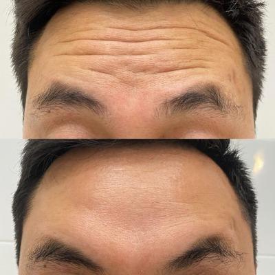 Botox for Forehead Lines, Crow’s Feet, and Frown Lines