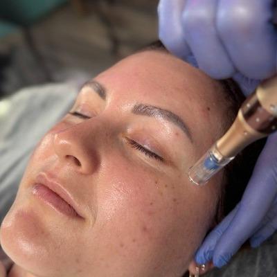 Can I wash my face after mesotherapy