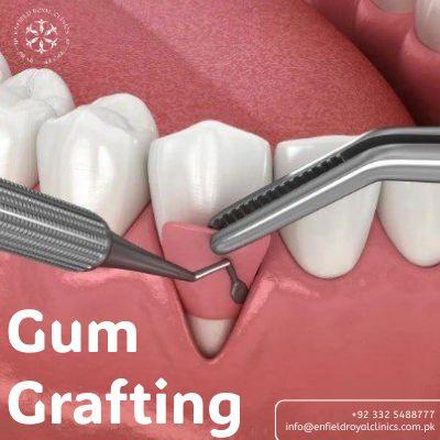 Gum grafting in islamabad