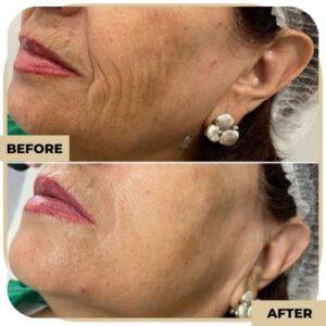 Hifu treatment in islamabad