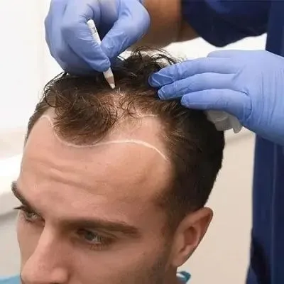 How Hair Transplant Works Step by Step