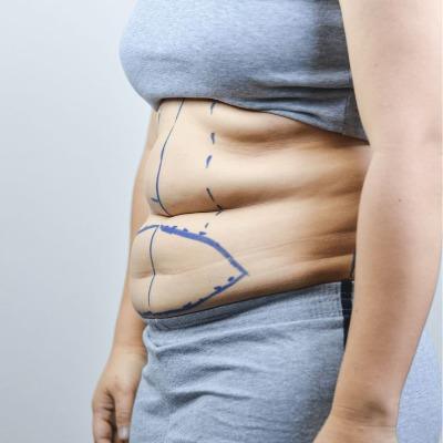 How Tummy Tuck Helps Remove Excess Belly Fat and Skin?