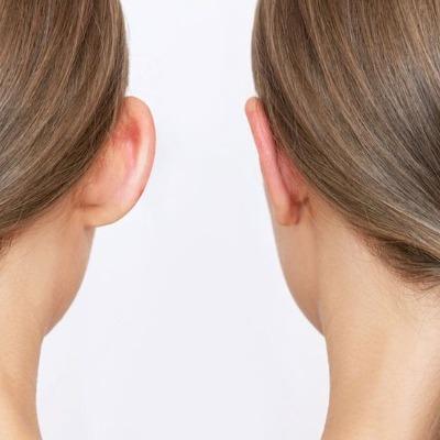 Otoplasty Ear Surgery Price in Pakistan