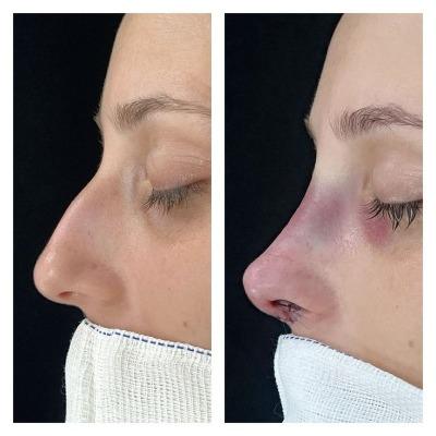 Rhinoplasty Healing Stages and Expectations