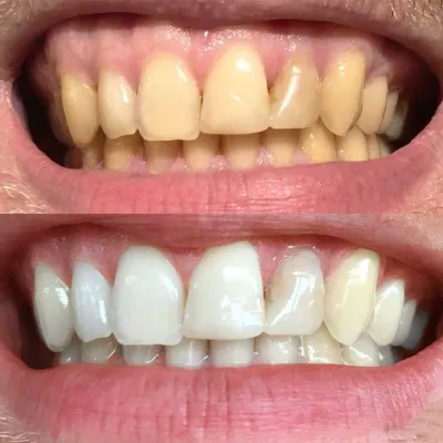 Teeth Whitening Price in Pakistan?