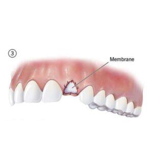 bone grafting in islamabad after