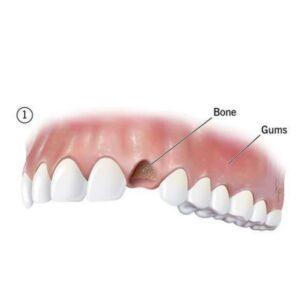 bone grafting in islamabad before