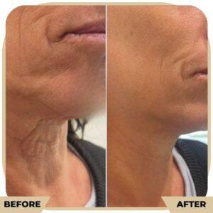 hifu before after treatment
