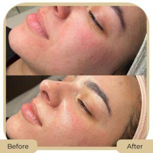 Bio Rae whitening Injections before after